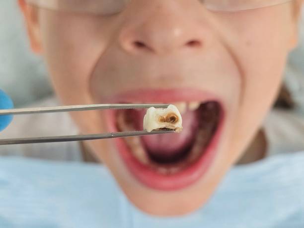 Best Emergency Treatment for Dental Infections or Abscesses in Kelly Ridge, CA